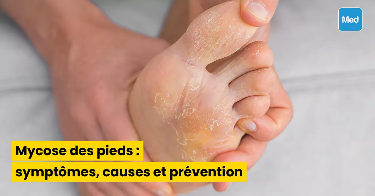 Mycose des pieds : symptômes, causes et prévention